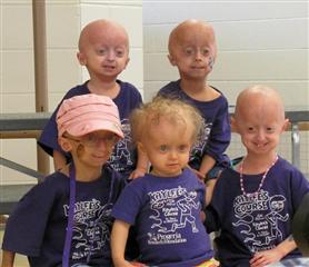 group of kids with progeria